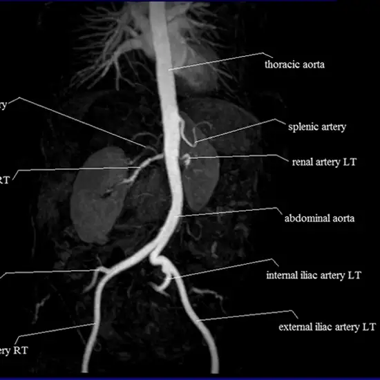 MR Angiography Thoracic Aorta